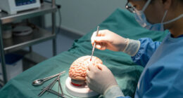 A Controversial Alzheimer's Surgery Is Said To Reverse Symptoms